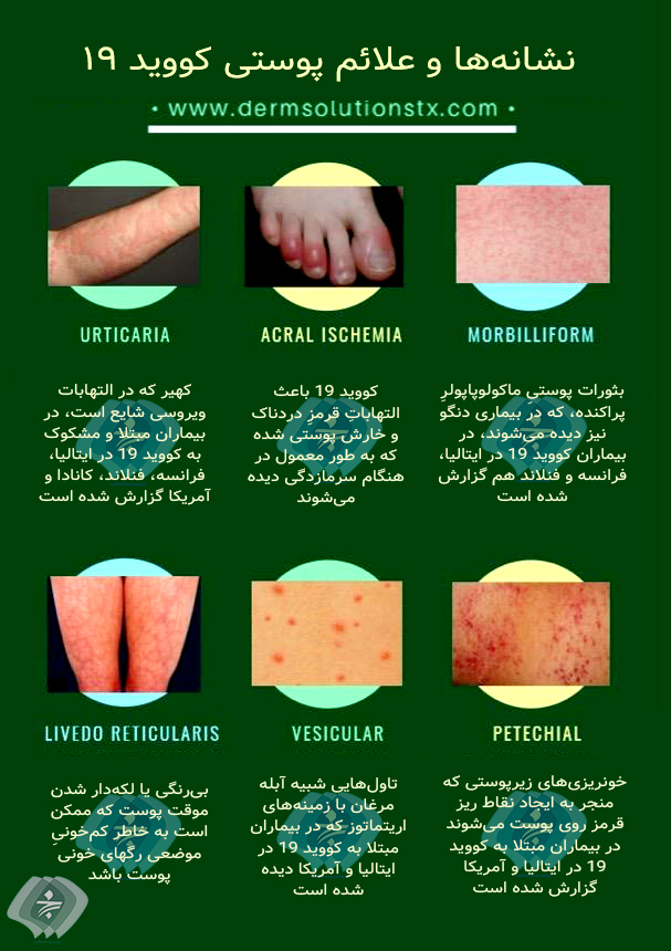 علائم پوستی ویروس کرونا علایم پوستی کرونا علایم کرونا بر پوست